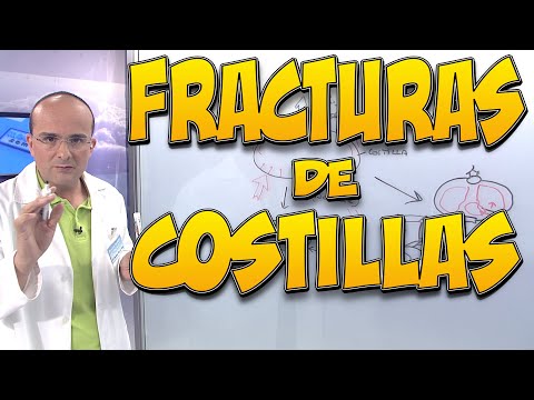 FRACTURAS DE COSTILLAS - Todo lo que necesita saber